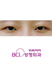 韩国BCI整形外科双眼皮手术案例对比图