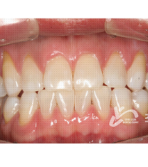 韩国CHOILEE牙科诊所-韩国CHOI&LEE牙科诊所牙齿美白日记对比图