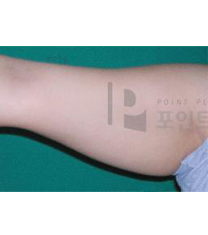 韩国POINT整形外科手臂吸脂日记对比图