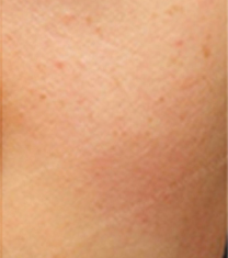 延世STARSKIN皮肤科祛红血色案例对比图