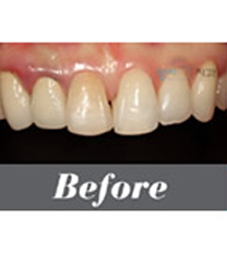 阳地齿科-阳地齿科牙齿矫正案例对比图