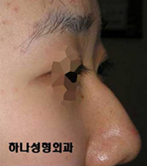韩国韩亚整形外科医院驼峰鼻矫正日记对比图