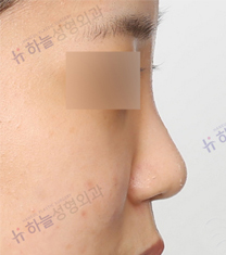 韩国哈娜儿整形外科隆鼻日记对比图