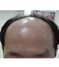 韩国HIGH MAN’S整形医院毛发移植案例对比图