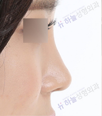 韩国哈娜儿整形外科-韩国哈娜儿整形外科隆鼻日记对比图