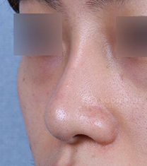 韩国SoonPlus整形外科鼻整形案例对比图