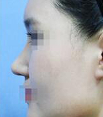 Members整形外科鼻部整形案例对比图