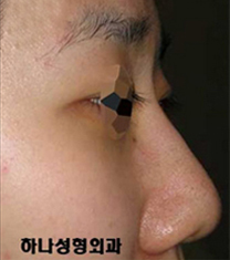 韩国韩亚整形外科医院驼峰鼻矫正日记对比图