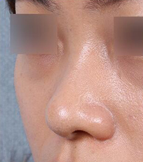 韩国SoonPlus整形外科鼻整形案例对比图