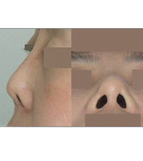 韩国Homme&Femme鼻整形研究所朝天鼻矫正案例对比图