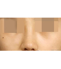 韩国I WANT整形外科隆鼻案例对比图