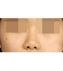 韩国I WANT整形外科隆鼻案例对比图