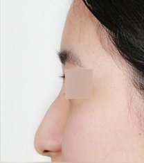 韩国纽莱茵整形医院驼峰鼻矫正案例对比图