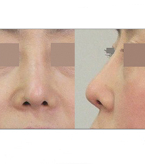 韩国Homme&Femme鼻整形研究所朝天鼻矫正日记对比图