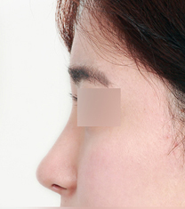 韩国纽莱茵整形医院驼峰鼻矫正案例对比图