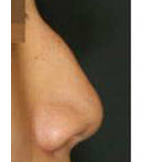 韩国Prima整形外科鹰钩鼻矫正日记对比图
