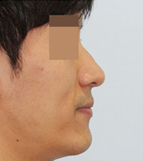 韩国定佑美容整形中心驼峰鼻矫正案例对比图