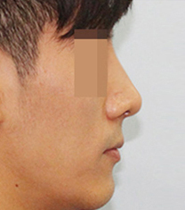 韩国定佑美容整形中心驼峰鼻矫正日记对比图