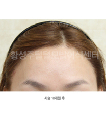 韩国SJ黄盛柱毛发皮肤医院种植发际线案例对比图