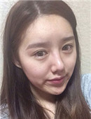 网友分享韩国ID颧骨+下颌角整形恢复日记