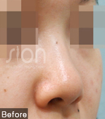 时蕴整形外科隆鼻案例对比图_术前