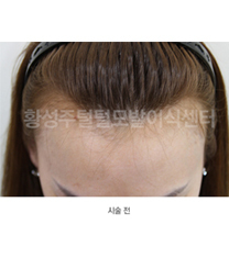 韩国SJ黄盛柱毛发皮肤医院种植发际线案例对比图