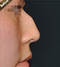 韩国多友整形医院-韩国多友整形医院驼峰鼻矫正案例对比图