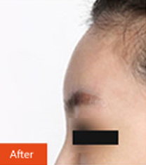 韩国Dr.O S.Clinic整形外科额头填充案例对比图