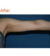韩国Dr.Min’s整形外科手臂吸脂案例对比图