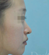 韩国DIVA整容外科医院隆鼻案例对比图