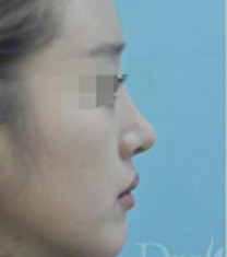 韩国DIVA整容外科医院隆鼻案例对比图_术后