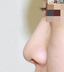 韩国Elle整形外科隆鼻案例对比图