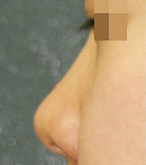 韩国KSJ整形外科隆鼻案例对比图
