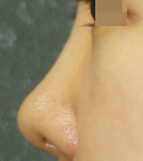 韩国KSJ整形外科隆鼻案例对比图