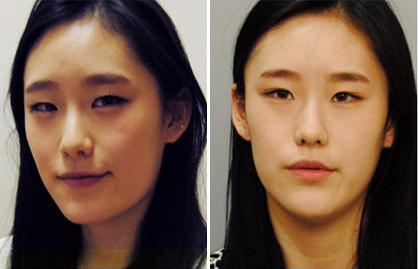 手术前求美者的面部形态