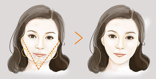 韩国ID和爱我整形外科做面部轮廓怎么样？