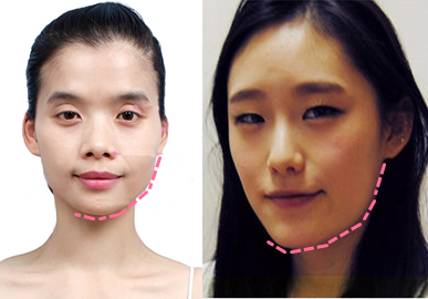 韩国ID和爱我整形外科做面部轮廓怎么样？