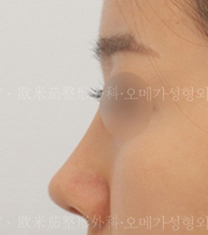 韩国omega整形外科医院隆鼻案例对比图_术后