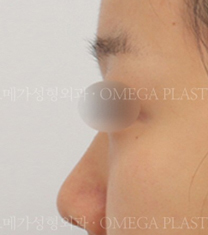 韩国omega整形外科医院隆鼻案例对比图