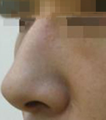 韩国i-Line整形外科驼峰鼻矫正日记对比图
