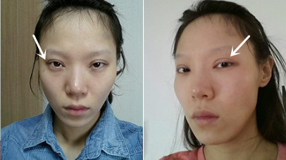 韩国灰姑娘和爱我整形外科双眼皮修复日记对比！