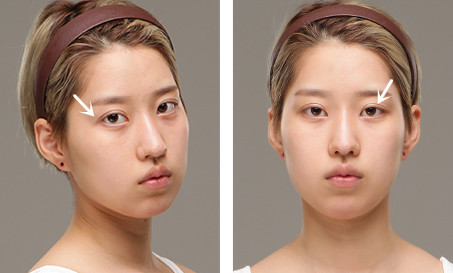 韩国灰姑娘和爱我整形外科双眼皮修复日记对比！