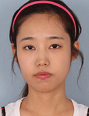 韩国巴诺巴奇整形外科-巴诺巴奇做凸嘴手术，术后效果好自然！