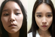 这三家韩国医院做面部轮廓，手术特色竟大不相同！