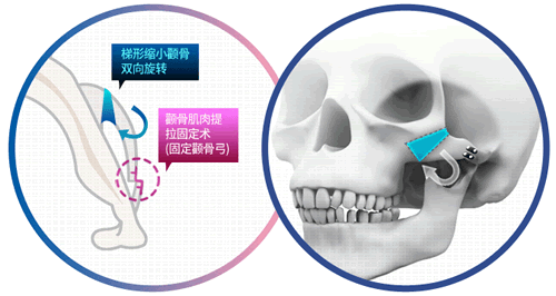 韩国TL医院做颧骨手术细节展示