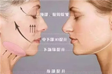 韩国希克丽医院面部线雕提升手术 瘦脸提升双功效