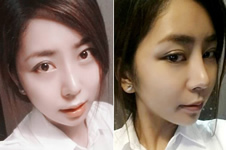 韩国TL做面部轮廓手术效果明显吗？