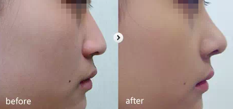 韩国艾恩整形外科隆鼻