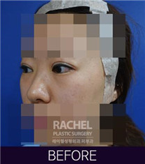 韩国Rachel整形医院双眼皮修复案例对比图_术前