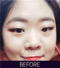 韩国Rachel整形医院misko隆鼻案例对比图
